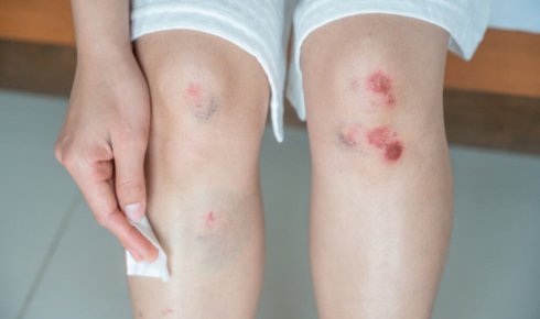 Can I Sue for Whiplash and Soft Tissue Injuries?